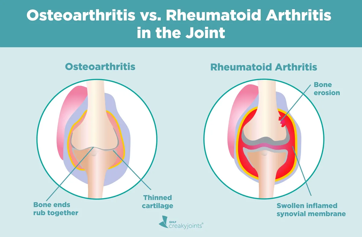 1119 ACR Osteoarthritis Vs Rheumatoid Logo