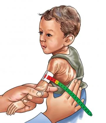 ACUTE MALNUTRITION