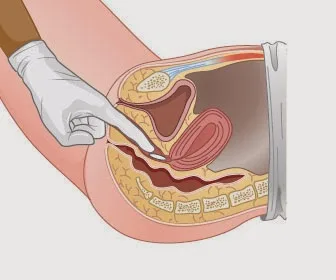 ADMINISTERING RECTAL AND VAGINAL MEDICATION