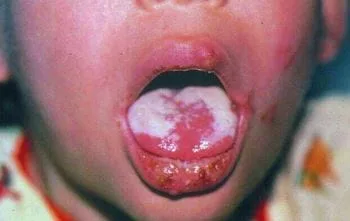 ASSESS Hiv