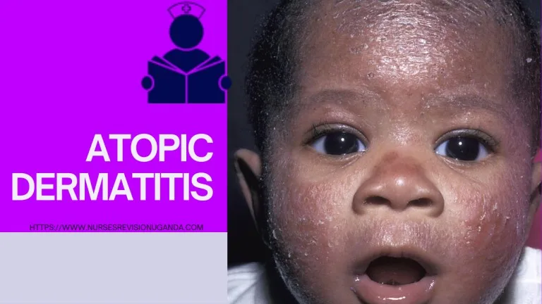 ATOPIC DERMATITIS