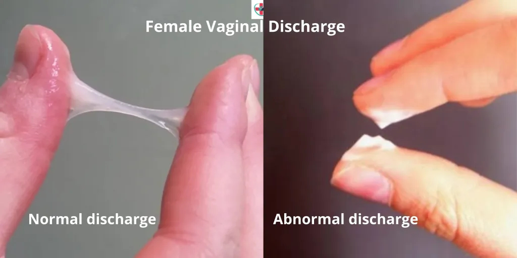 Abnormal Vaginal Discharge Syndrome