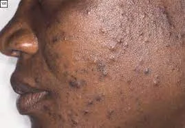 Acne Vulgaris