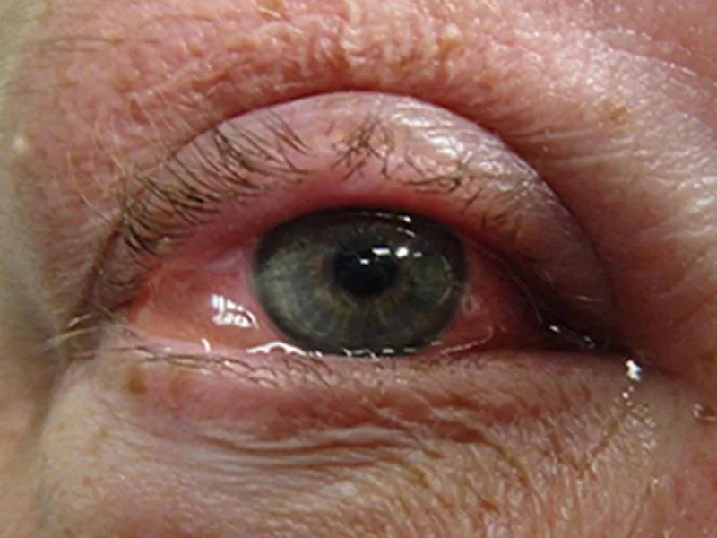 Allergic Conjunctivitis Everything You Need To Know