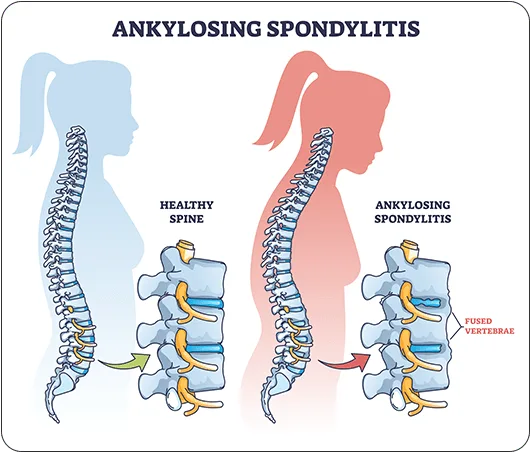 Ankylosing Spondylitis