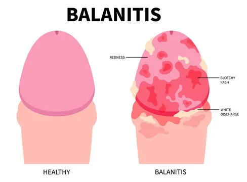 BALANITIS