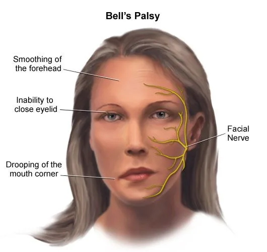 BELLS PALSY FACIAL NERVE PALSY