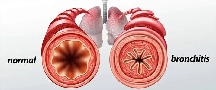 BRONCHITIS E1753163173994