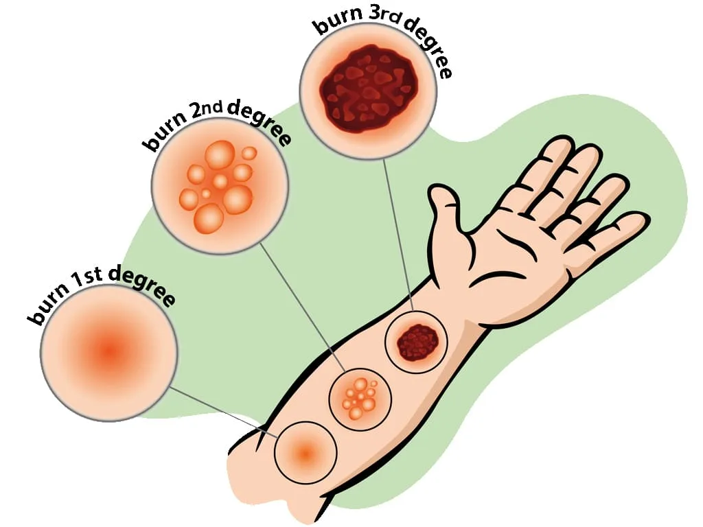BURNS NURSES REVISION UHPAB 1