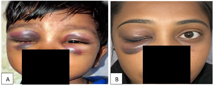 Blunt Trauma To The Eye