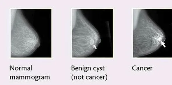 Breast Cancer