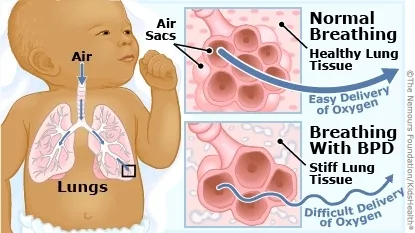 Broncho Pulmonary Dysplasia