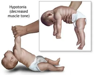 CEREBRAL PALSY Hypotonia