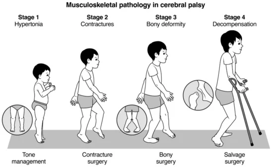 CEREBRAL PALSY Pathology