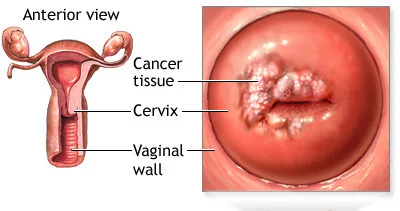 CERVICAL CANCER E1717783428933