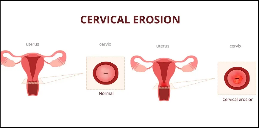 CERVICAL ECTROPION CERVICAL EROSION