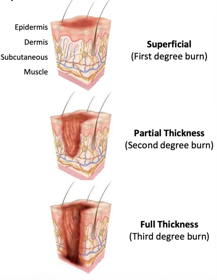 CLASSIFICATION OF BURN INJURY