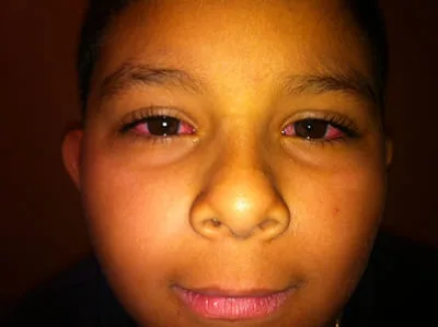 CONJUNCTIVITIS 1