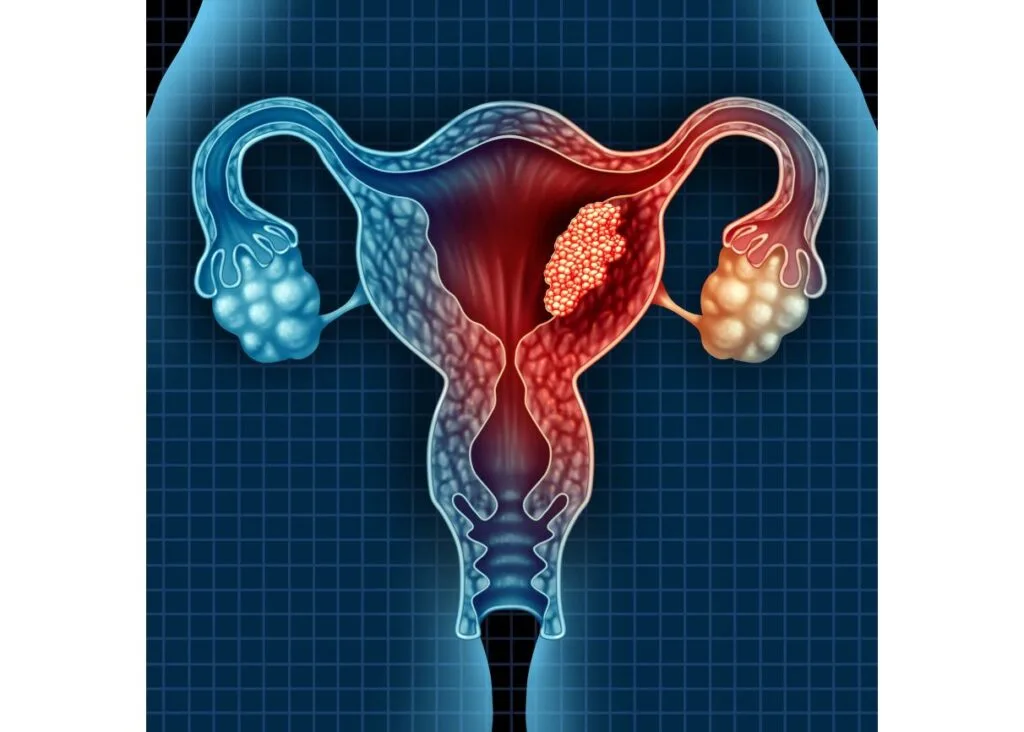 Cancers Of Reproductive Health Organs 1