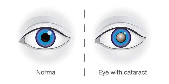 Cataract Eye