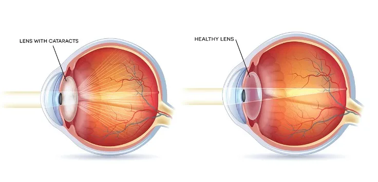 Cataract Vision