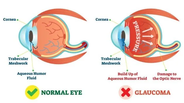 Causes Aetiology Of Glaucoma 1 E1708185472792