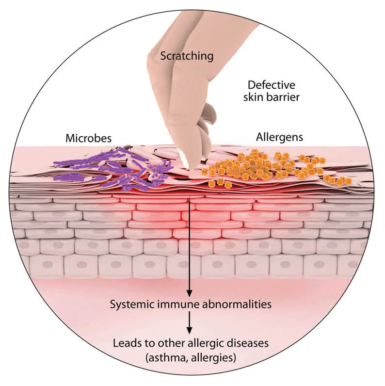 Causes Of Eczema