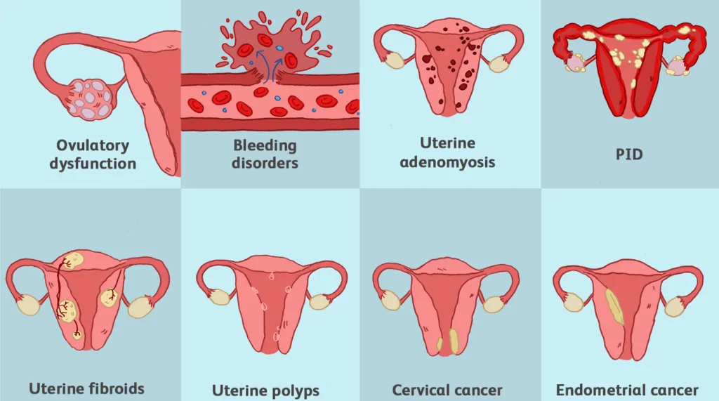 Causes Of Menorrhagia E1705240297408
