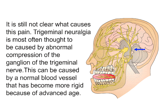 Causes Of Trigeminal Neuralgia