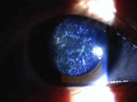 Cerulean Cataract