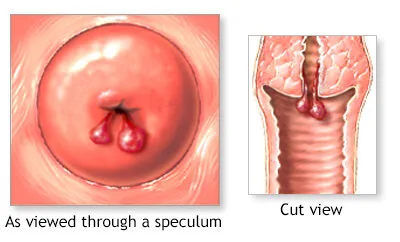 Cervical Polyps E1705554520430