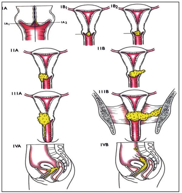 Cervical Cancer Staging 1