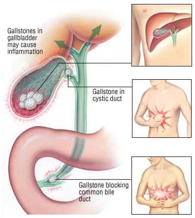 Cholecystitis