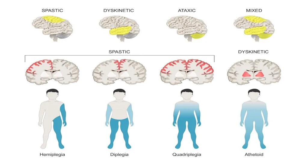 Classification Types Of Cerebral Palsy E1703154255791