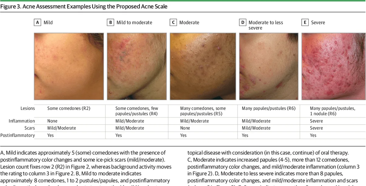 Classification And Severity Assessment Of Acne Vulgaris 1