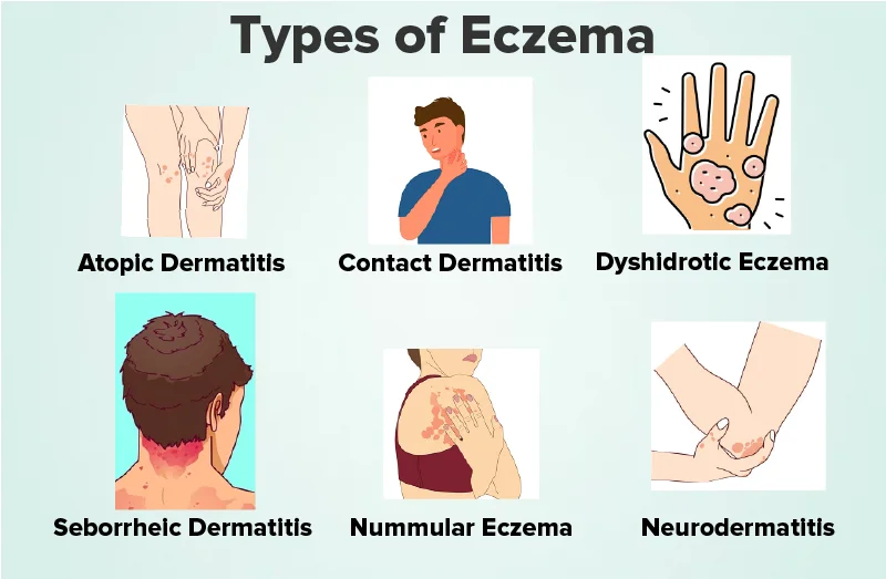 Classification Of Eczema