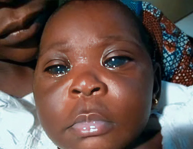 Classification Of Glaucoma Congenital