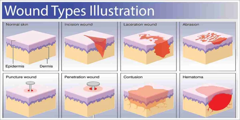 Classification Of Wounds