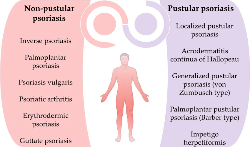Classification Of Psoriasis Clinical Forms 1
