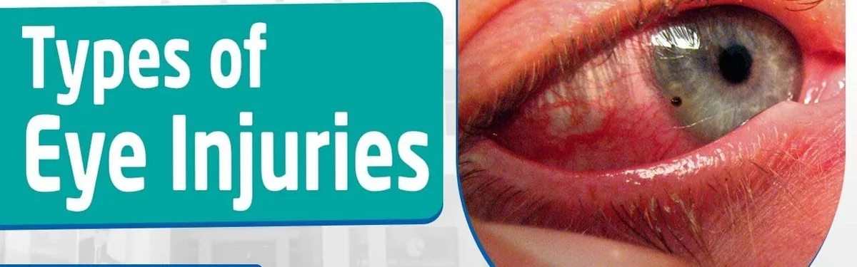 Classifications Of Eye Injuries 1 E1732863497555