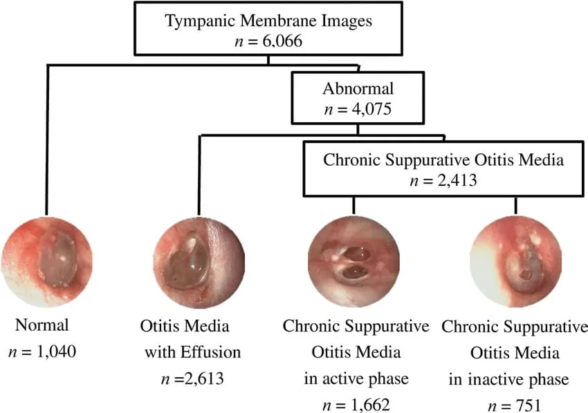 Classifications Of Otitis Media 1