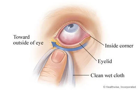 Cleaning Of The Eye