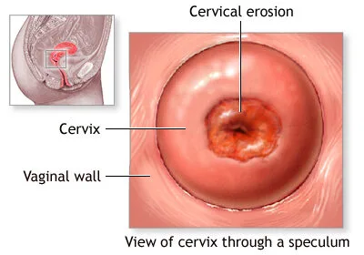 Clinical Features Of Cervical Erosion E1705554551827