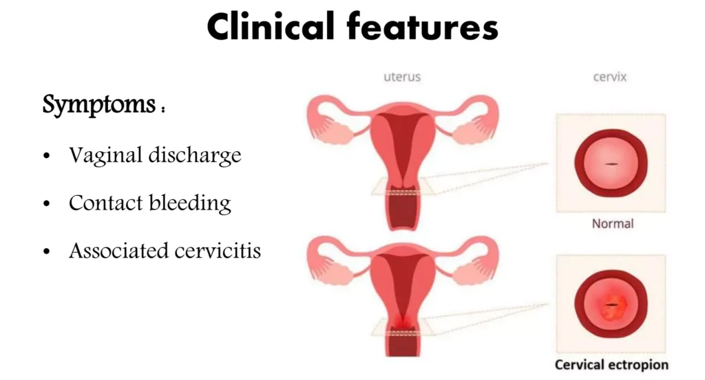Clinical Features Of Cervical Erosion S E1705554587531