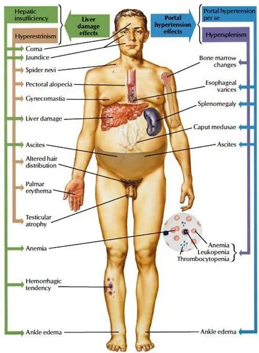 Clinical Features Of Liver Cirrhosis