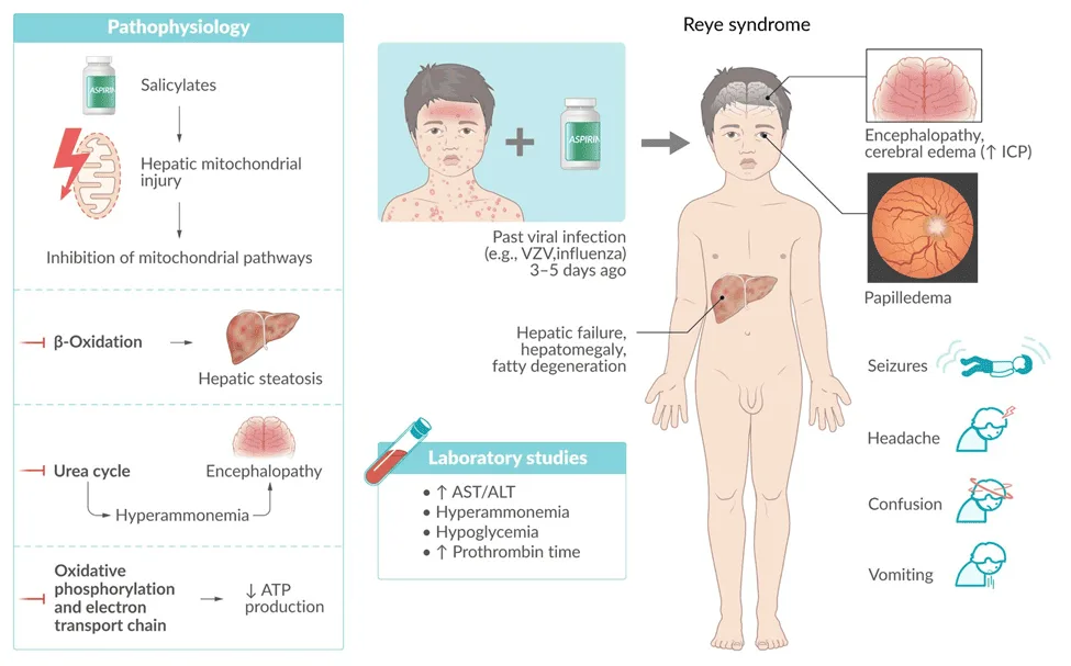 Clinical Features Of Reyes Syndrome 1