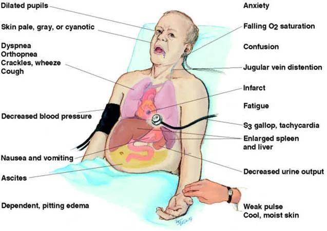 Clinical Manifestations Signs And Symptoms Of Heart Failure