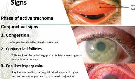 Clinical Manifestations Signs And Symptoms Of Trachoma 1