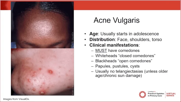 Clinical Manifestations Of Acne Vulgaris 1