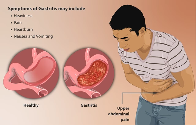 Clinical Manifestations Of Acute Gastritis